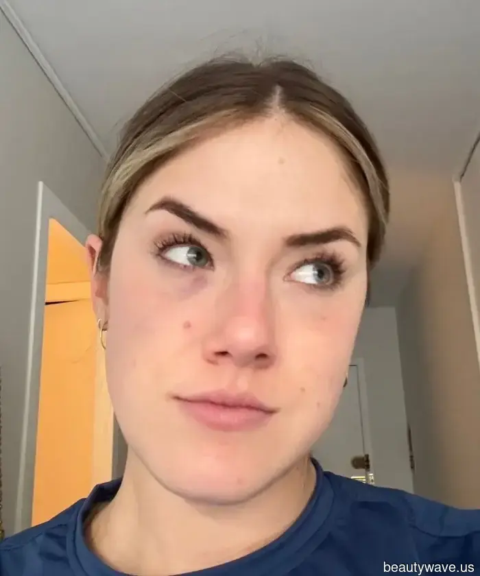 I Tested PRP for My Fatigued Under-Eyes—Here’s What Happened.