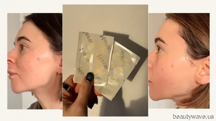 I Tried the Internet's Most Popular Spot Treatments—Here’s Why They Deserve the Attention