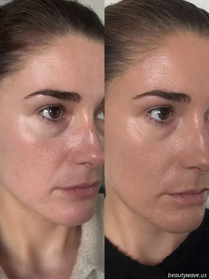 Ich habe die Hebe- und-formende Behandlung als Botox-Alternative ausprobiert – Das sind meine Ergebnisse nach 3 Monaten