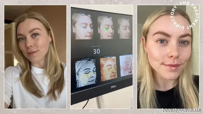 After experiencing this injectable skin treatment for the first time, my radiance has reached new heights.