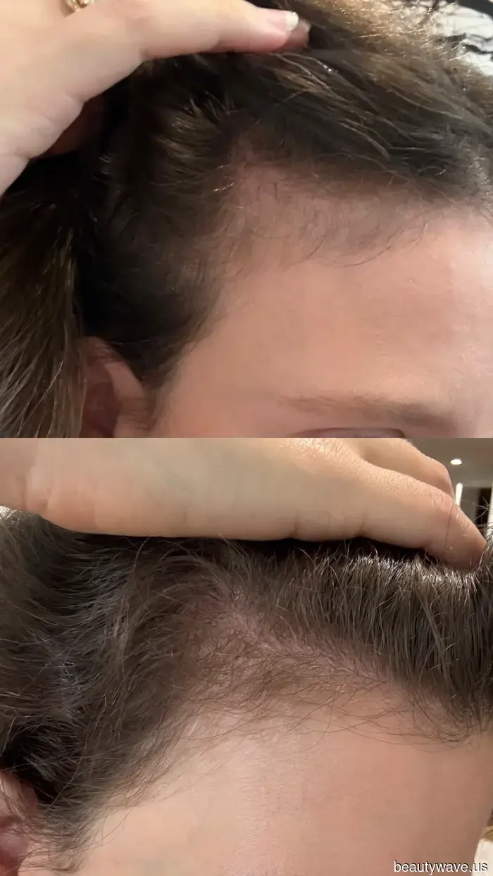 I Tried Nutrafol's Enhanced Hair-Growth Supplement—Here's What Happened After 5 Months.