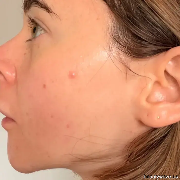 I Tried the Internet's Most Popular Spot Treatments—Here’s Why They Deserve the Attention