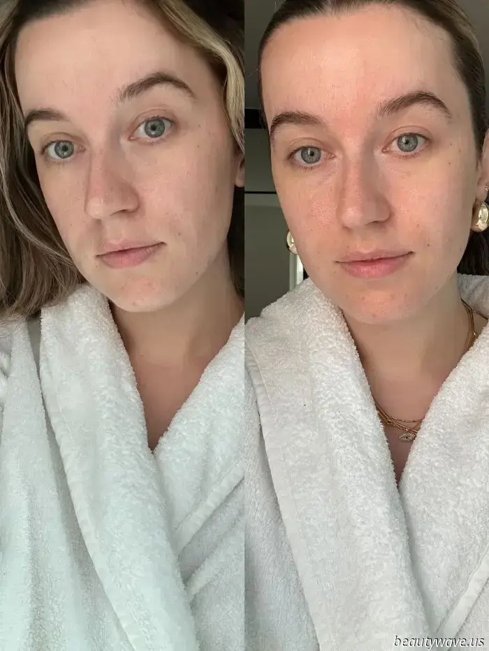 I recently tested a high-tech "Zit Zapper" to find out if it could help clear my hormonal breakout.