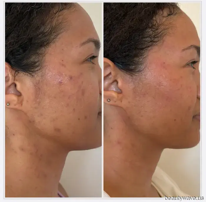 I've experimented with numerous treatments—this is the only one that has genuinely transformed my damaged, acne-prone skin.