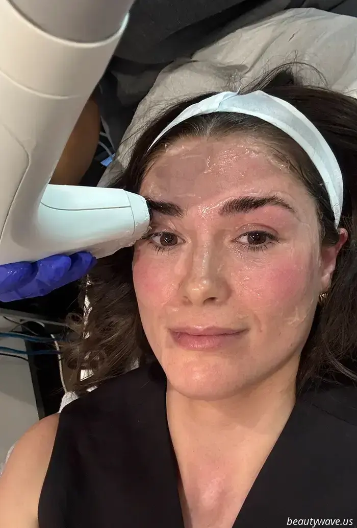 Ich habe die Hebe- und-formende Behandlung als Botox-Alternative ausprobiert – Das sind meine Ergebnisse nach 3 Monaten