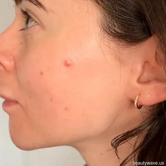 I Tried the Most Popular Spot Patches on the Internet—Here’s Why They Deserve the Attention