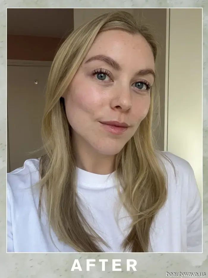 After experiencing this injectable skin treatment for the first time, my radiance has reached new heights.