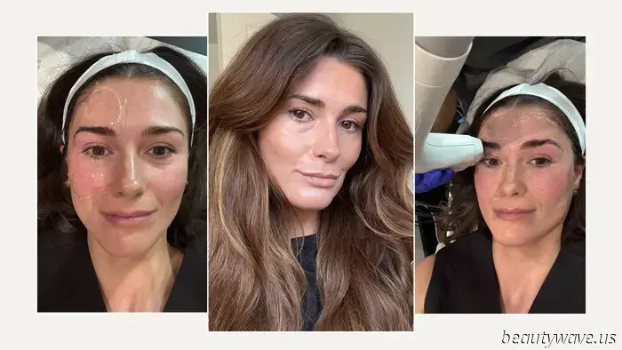 Ho provato il trattamento di sollevamento e modellatura come alternativa al Botox – ecco i miei risultati dopo 3 mesi
