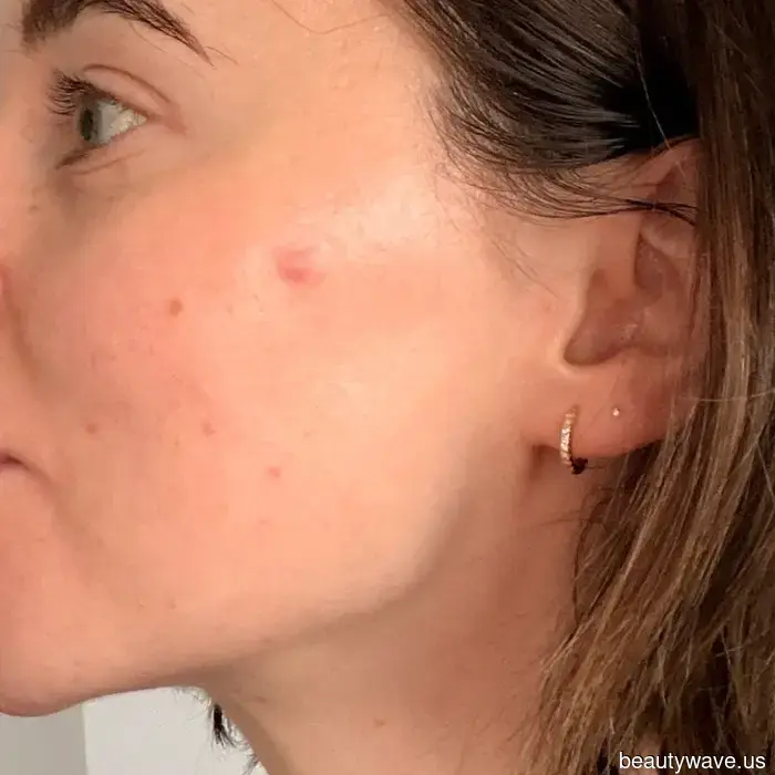 I Tried the Most Popular Spot Patches on the Internet—Here’s Why They Deserve the Attention