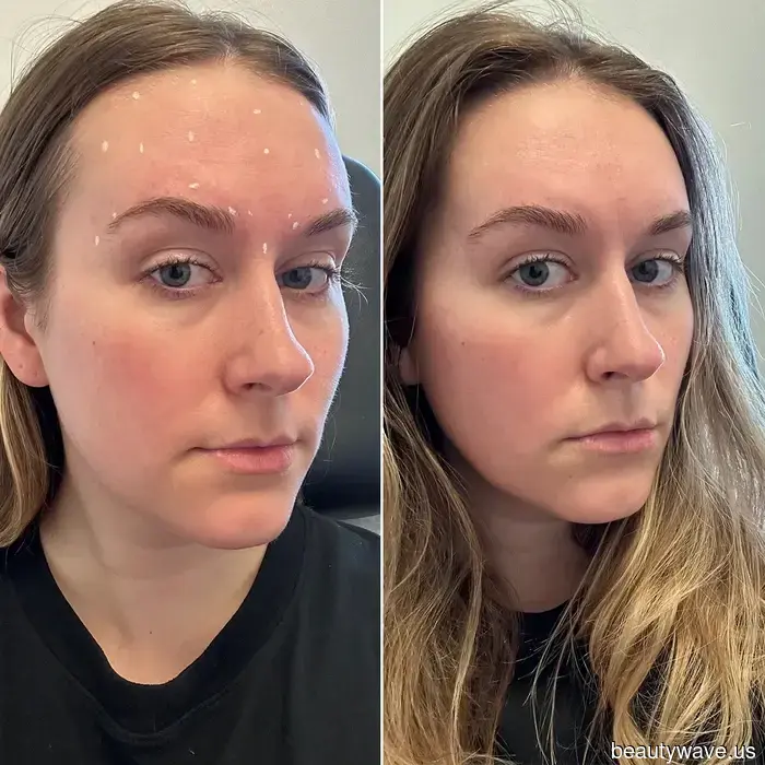 I'm Utilizing Copper Peptides to Boost the Effects of My Botox—Here’s the Reason.