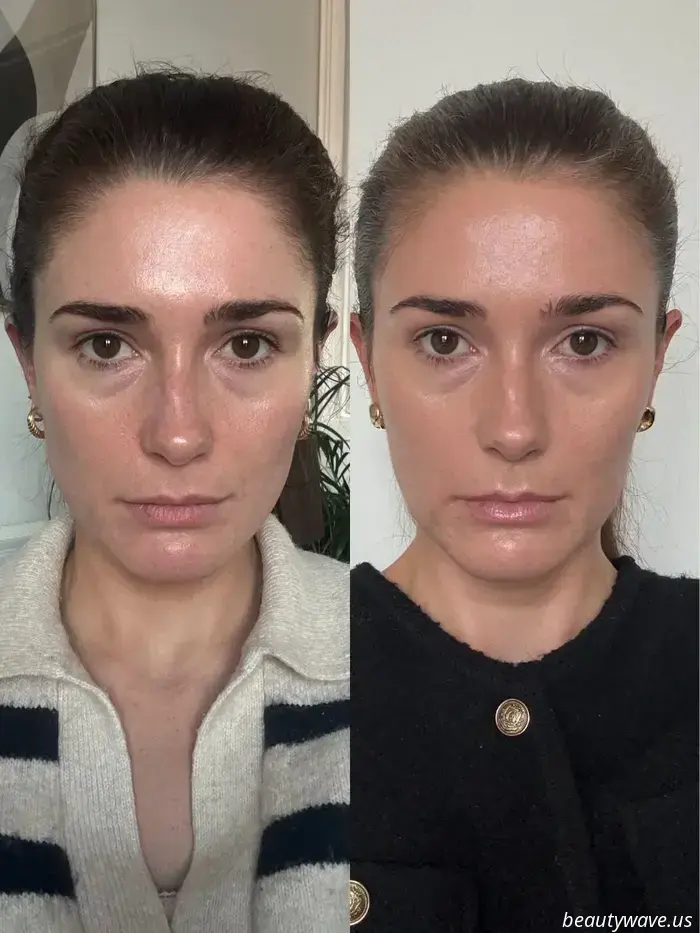 Ich habe die Hebe- und-formende Behandlung als Botox-Alternative ausprobiert – Das sind meine Ergebnisse nach 3 Monaten