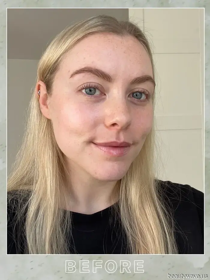 After experiencing this injectable skin treatment for the first time, my radiance has reached new heights.